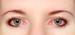conjuntivitis shutterstock