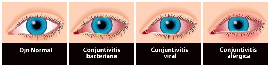 conjuntivitis