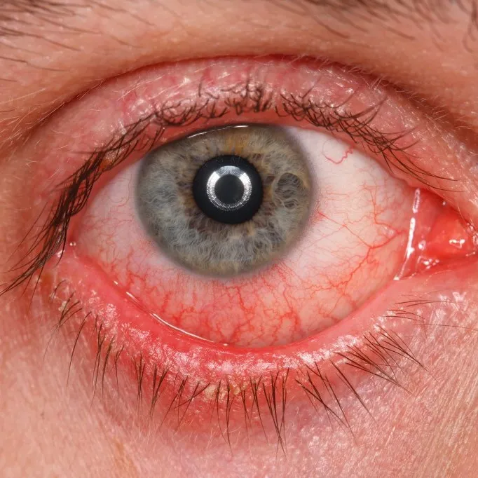 Conjuntivitis - Patología frecuente en VIU - Clínica Oftalmológica Internacional