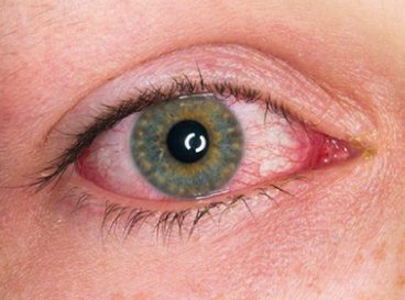 Img Uveitis
