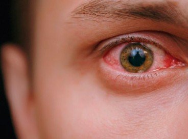 Img conjuntivitis