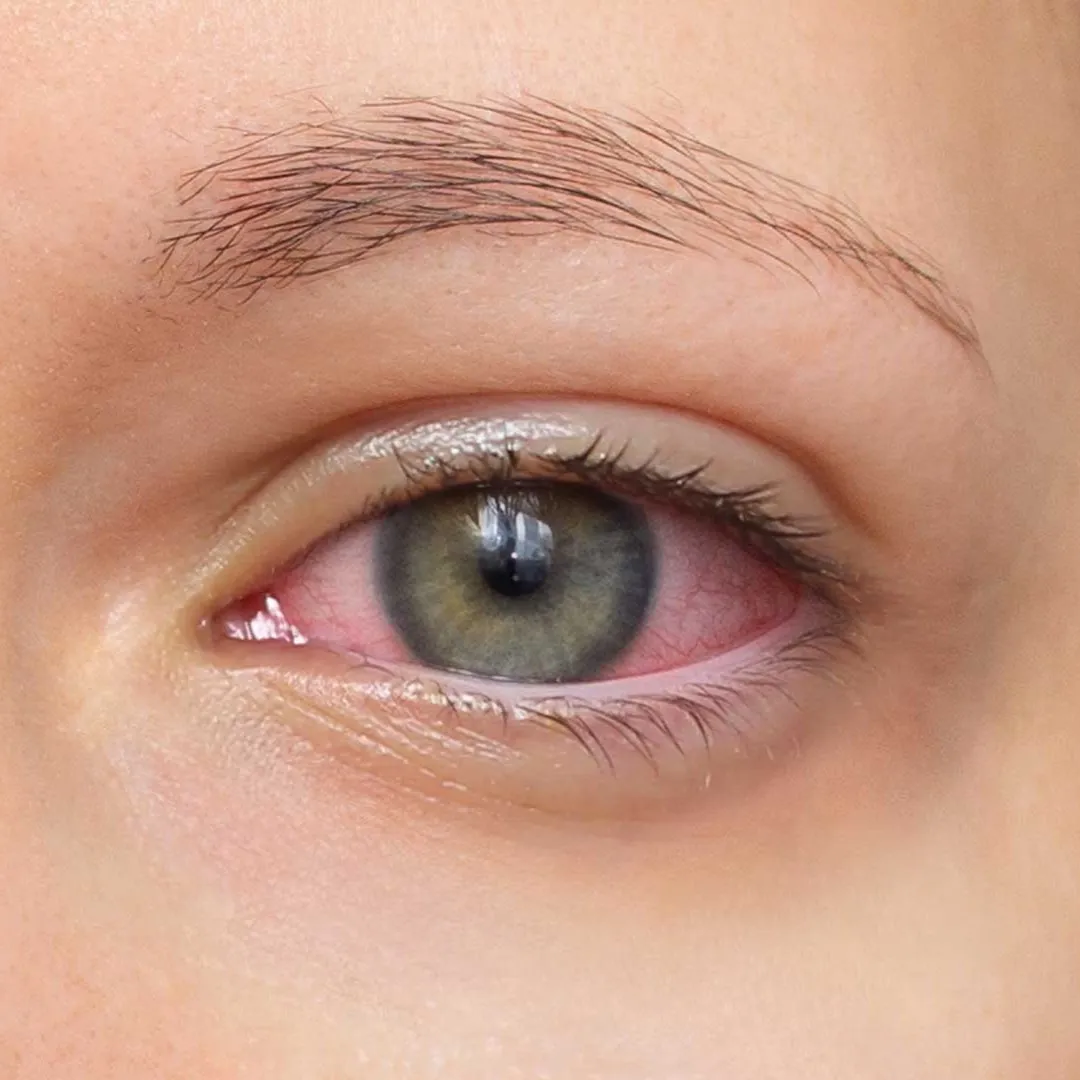 Uveitis - Patologías frecuentes en VIU - Clínica Oftalmológica Internacional