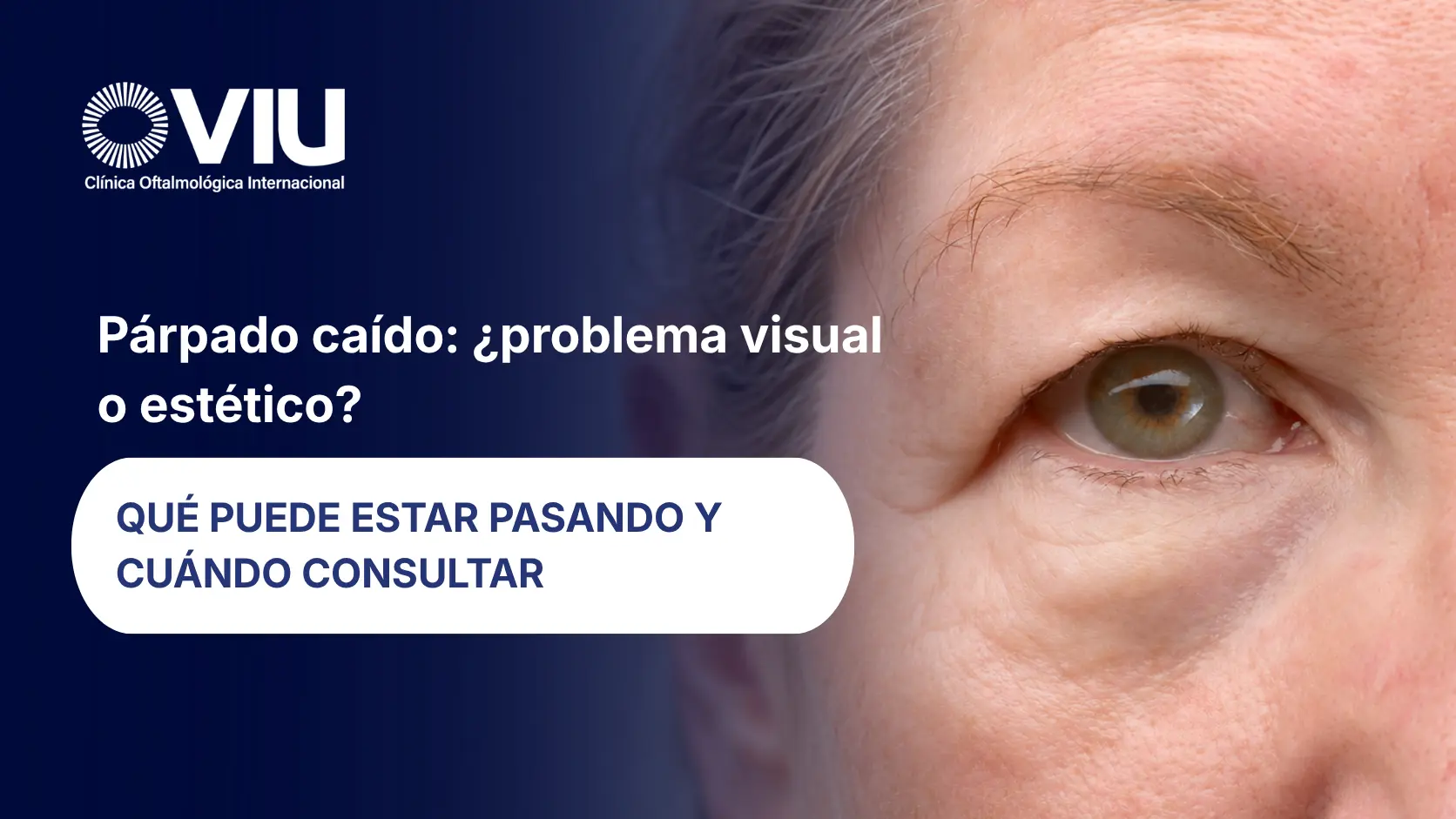 Párpado caído causas y tratamientos - VIU Clínica Oftalmológica Internacional - Barranquilla, Colombia