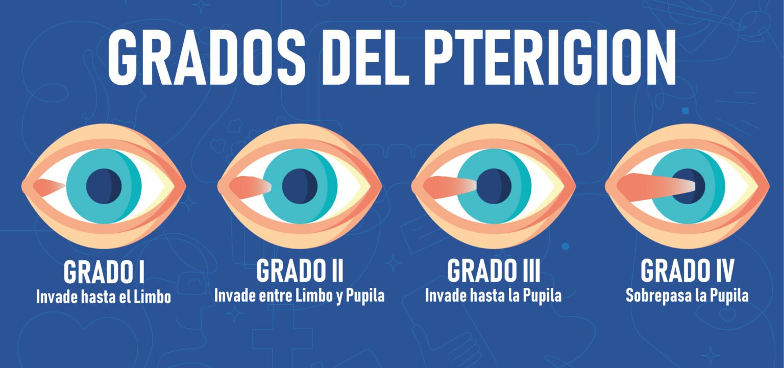 Cirugía de pterigión - VIU Clínica Oftalmológica Internacional