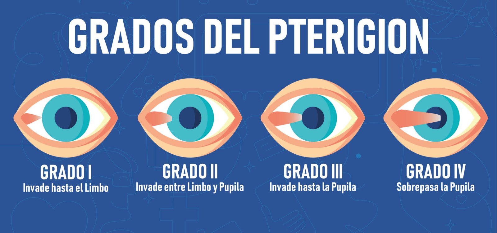 Piterigeno Cirugía de pterigión - VIU Clínica Oftalmológica Internacional