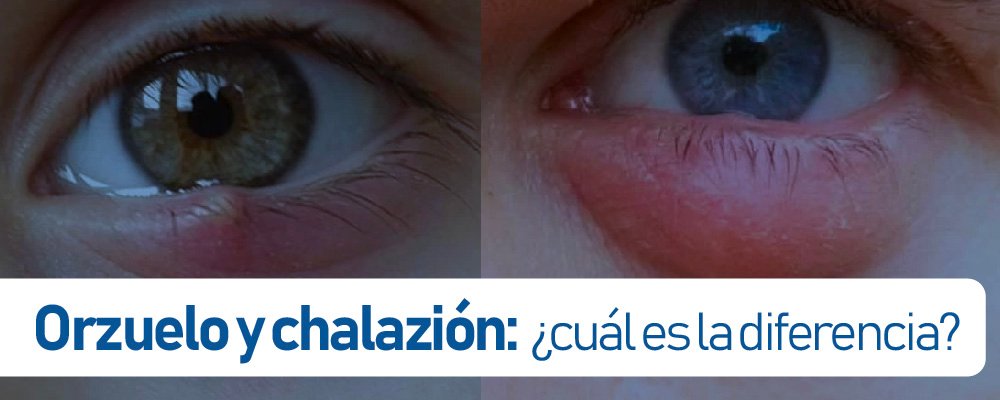 orzuelo y chalazion