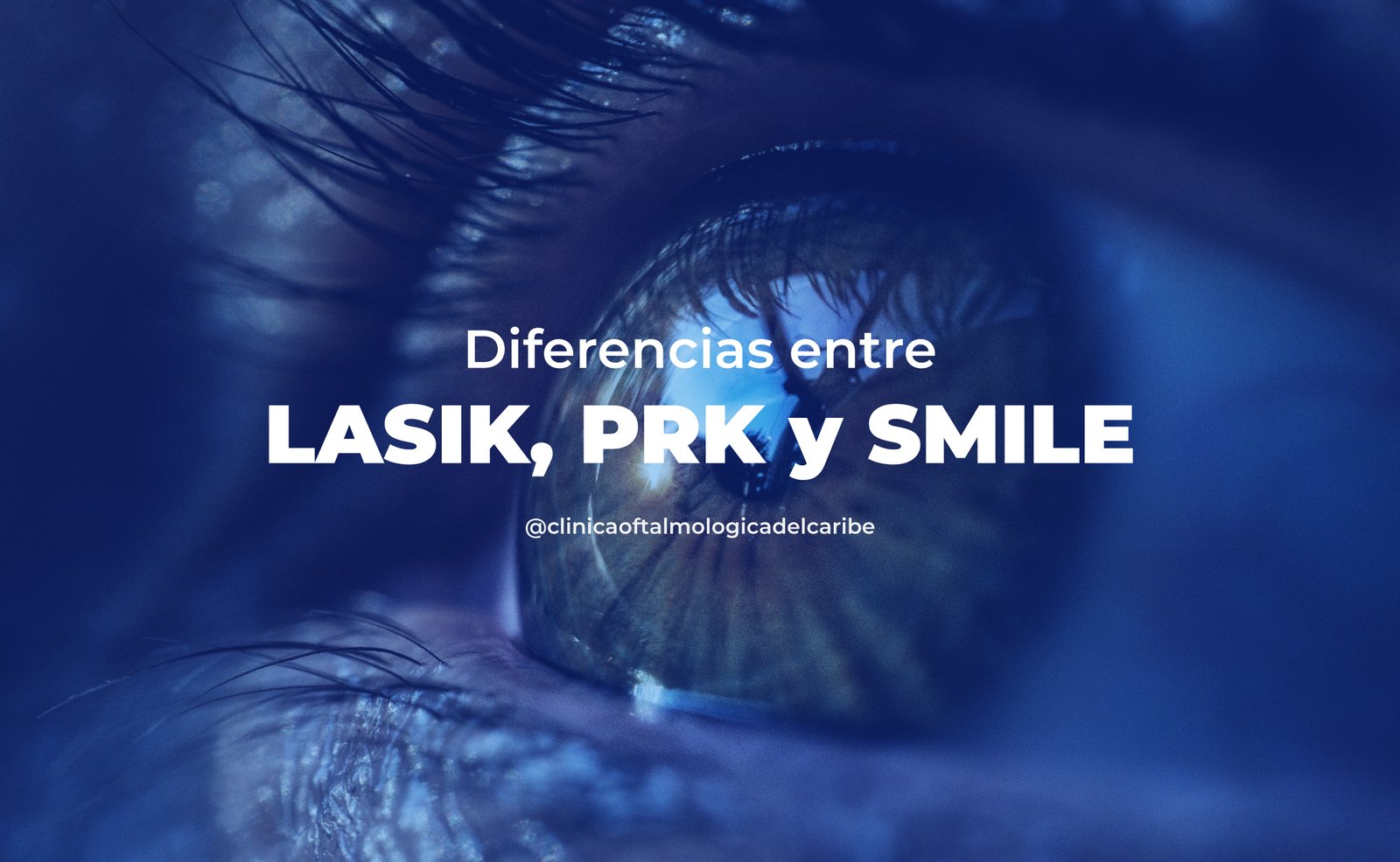 Diferencias entre Lasik y SMILE - Cofca Barranquilla