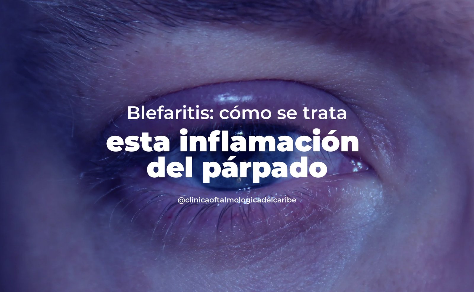 Tratamiento de blefaritis en COFCA Barranquilla: higiene ocular con toallitas y compresas tibias, antibióticos tópicos/orales, esteroides e ivermectina para casos de Demodex