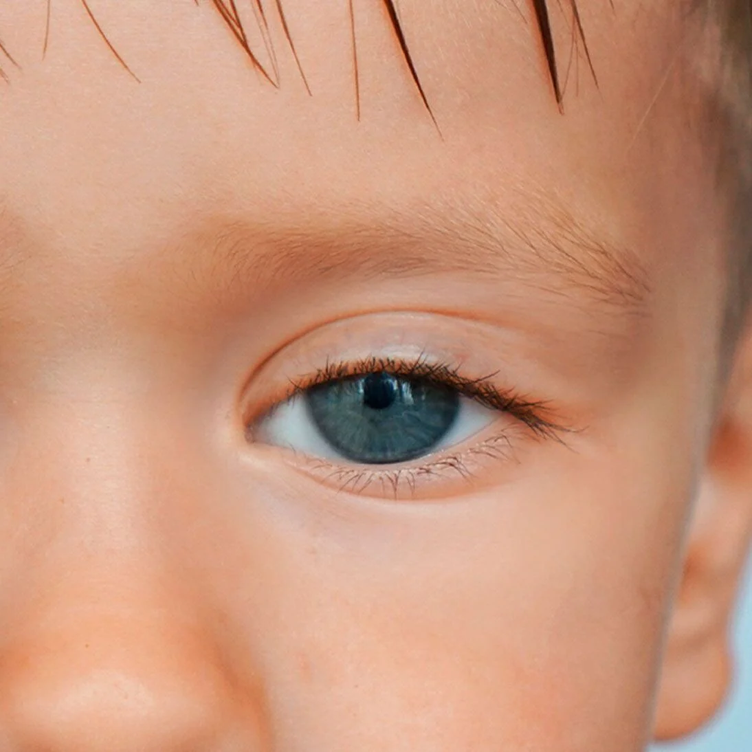 Tratamiento con cirugía para la ptosis palpebral en VIU - Clínica Oftalmológica Internacional en Barranquilla Colombia