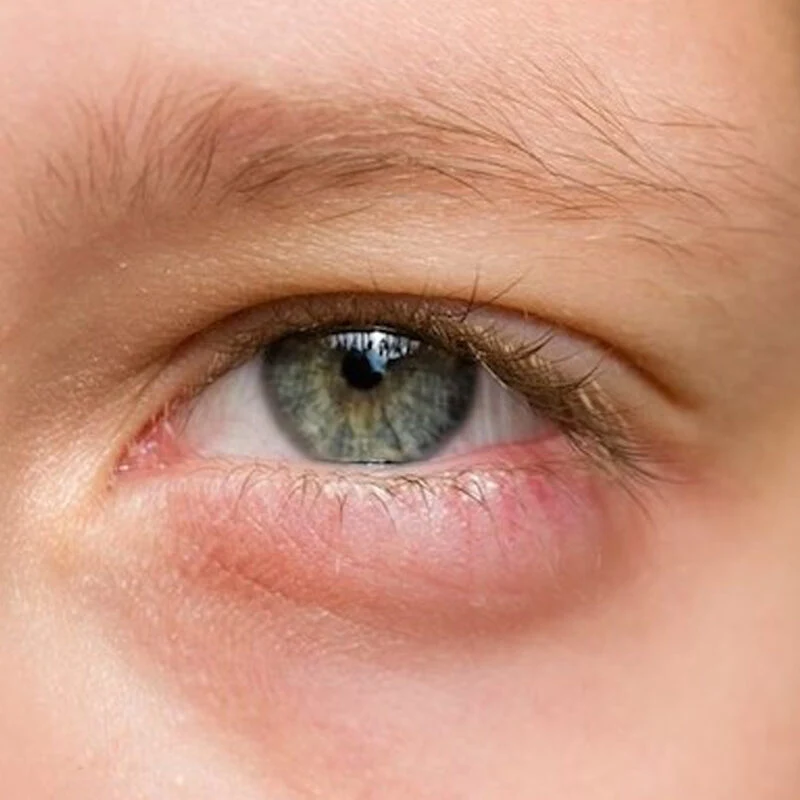 Tratamiento para tumores palpebrales - Cirugía para tumor palpebral en VIU - Clínica Oftalmológica Internacional en Barranquilla Colombia