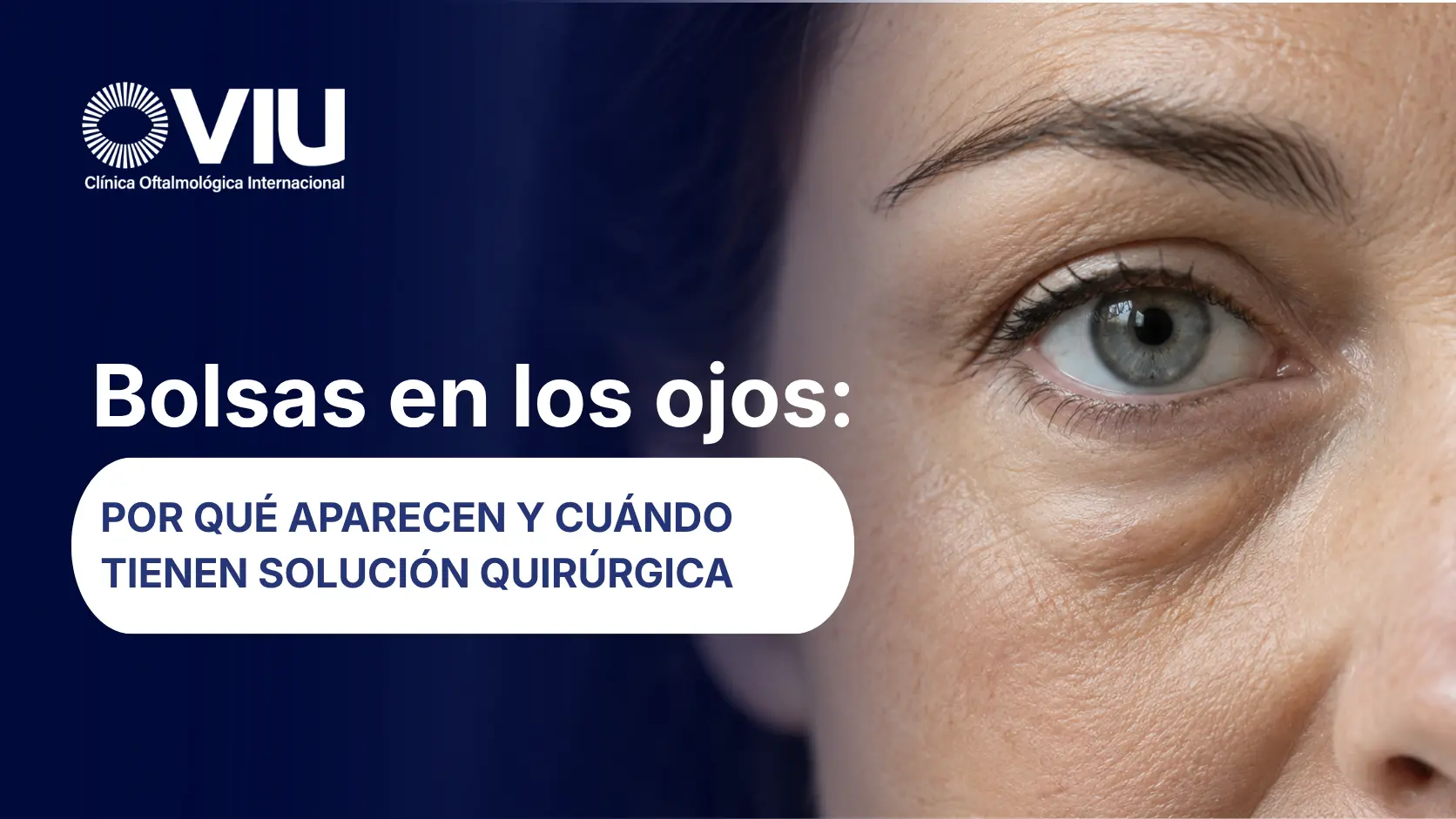Bolsas en los ojos por qué aparecen y cuándo tienen solución quirúrgica - VIU Clínica Oftalmológica Internacional - Barranquilla, Colombia