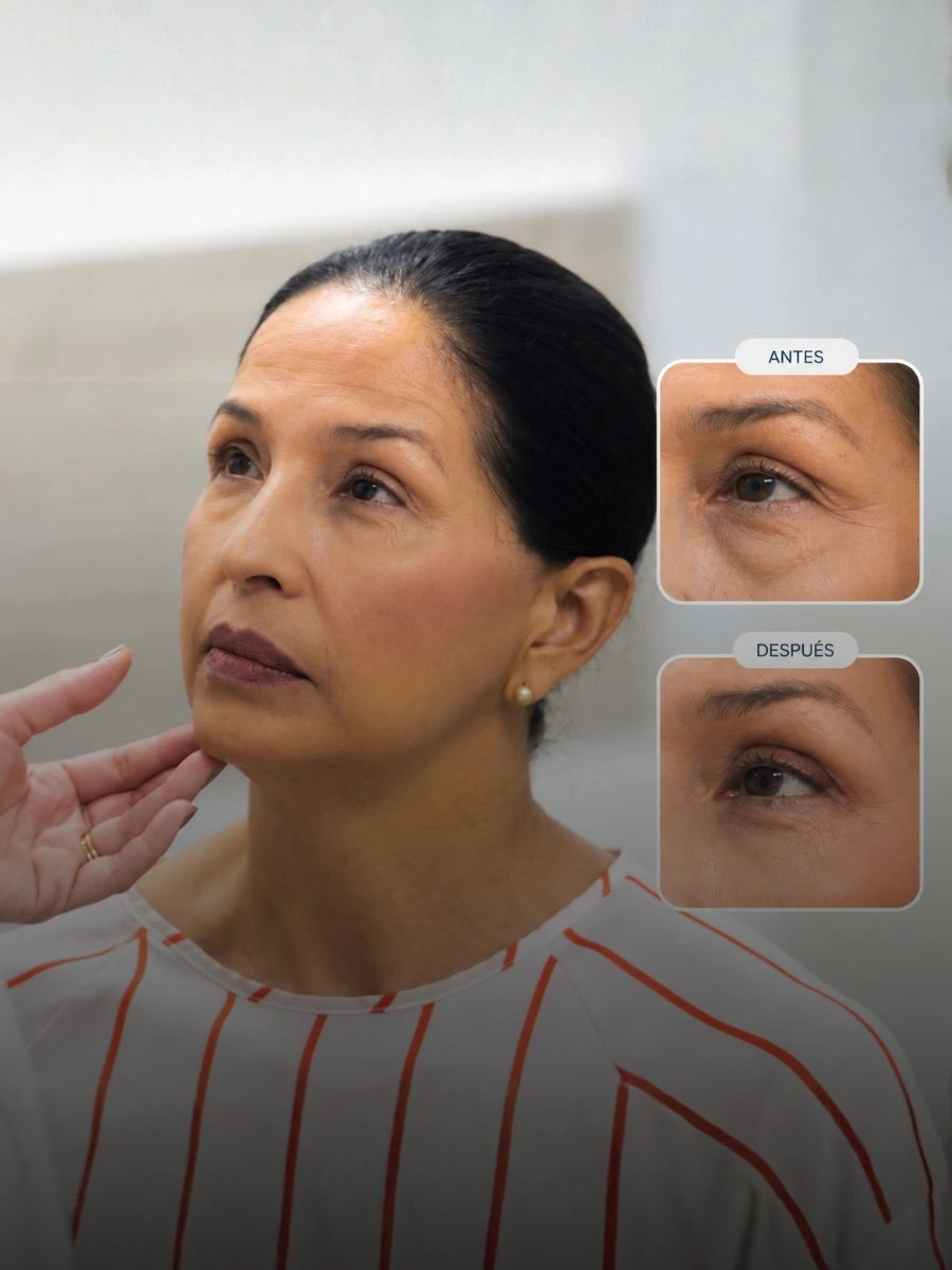 Paciente de blefaroplastia en VIU Clínica Oftalmológica Internacional, Barranquilla