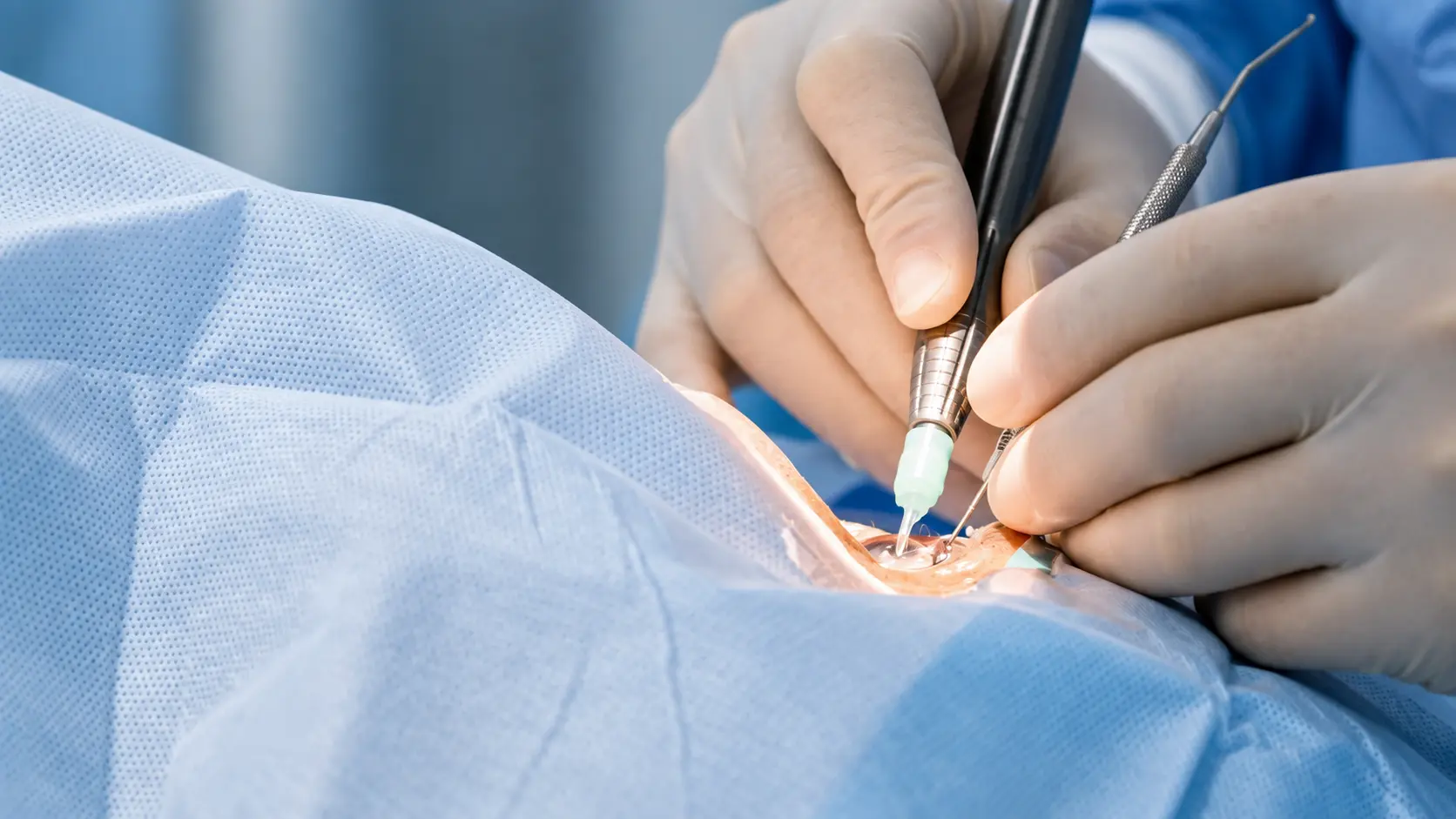 Vitrectomía con microincisiones para el tratamiento quirúrgico de la retina en VIU Clínica Oftalmológica Internacional