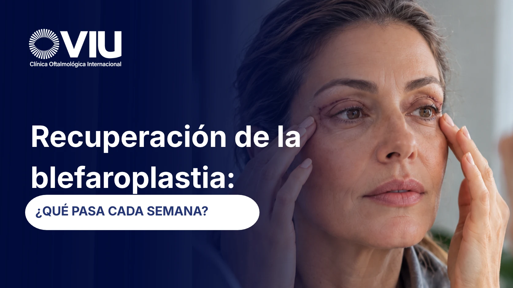 Recuperación de la blefaroplastia: ¿Qué pasa cada semana?