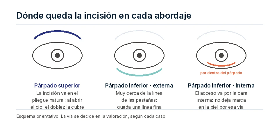 Esquema de tres ojos que muestra dónde queda la incisión: en el pliegue del párpado superior, bajo las pestañas en el inferior externo y por la cara interna del párpado en el abordaje transconjuntival